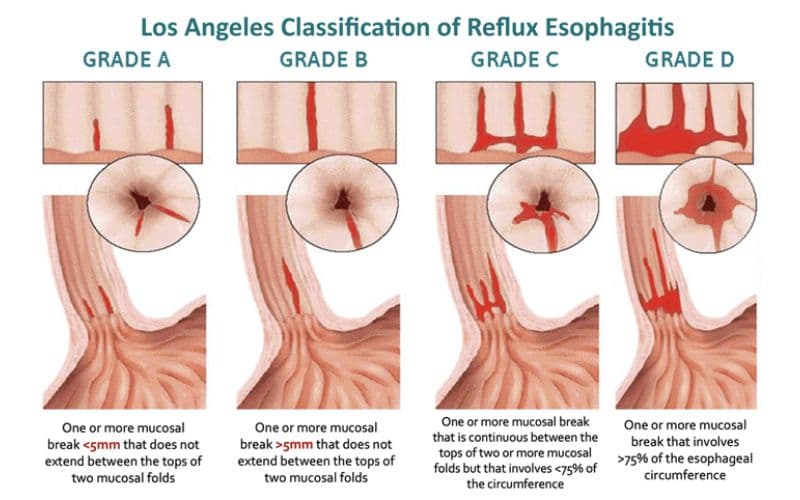 trào ngược dạ dày độ B