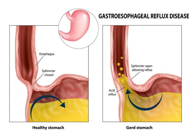 Nguyên nhân gây ợ chua trào ngược axit dạ dày lên thực quản