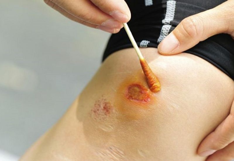 xử lý vết thương phần mềm đúng cách