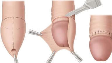 Cắt bao quy đầu: lợi ích, quy trình và một số lưu ý