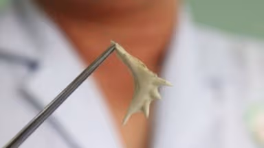 Cách chữa hóc xương: Từ nguyên nhân đến giải pháp