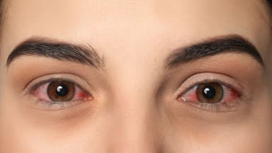 Cách trị đau mắt đỏ tại nhà hiệu quả