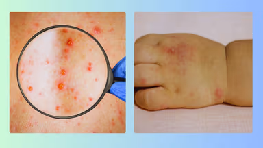 Hướng dẫn phân biệt dấu hiệu bệnh thủy đậu và tay chân miệng