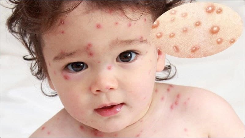 Dấu hiệu khỏi bệnh thủy đậu ở trẻ như thế nào?