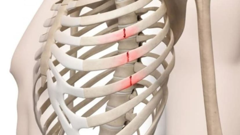 Cẩn trọng với những dấu hiệu gãy xương sườn