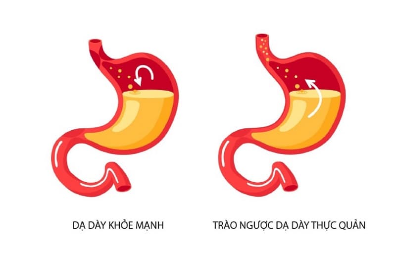 Nguyên nhân gây ợ nóng