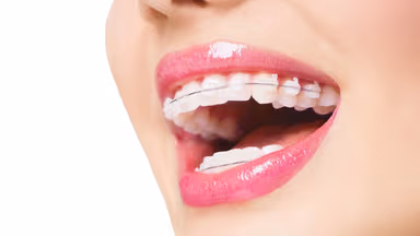 Niềng răng hô hàm trên – Những thông tin cần thiết