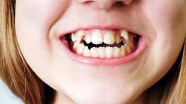 Niềng răng khểnh: Giải pháp cho nụ cười đẹp hơn