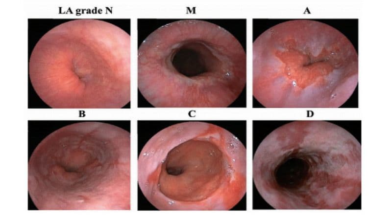 phân độ trào ngược dạ dày thực quản chia thành mấy loại?