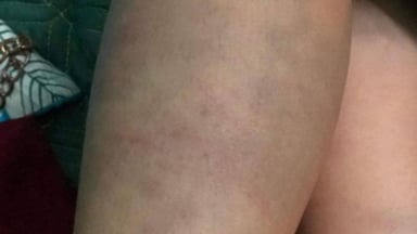 Cẩn trọng với chấn thương phần mềm ở bắp chân