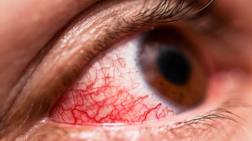 Hướng dẫn cách chữa đau mắt đỏ hiệu quả mùa mưa lũ