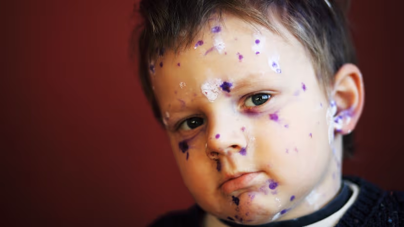 Nốt thủy đậu mưng mủ: Hướng dẫn bố mẹ xử lý