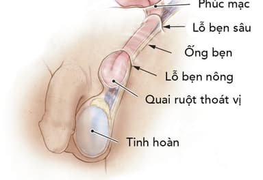 Phẫu thuật thoát vị bẹn bằng nội soi