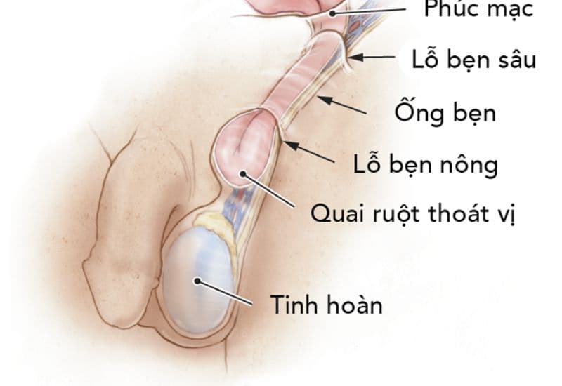 Phẫu thuật thoát vị bẹn bằng nội soi