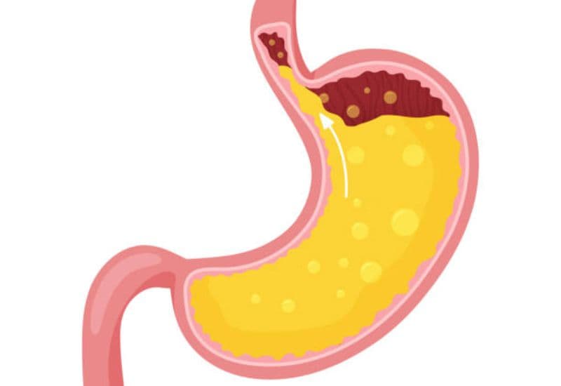 Trào ngược axit dạ dày là gì?