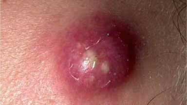 Tự ý nặn mụn u bã đậu tại nhà coi chừng khối u hoại tử, dễ tái phát