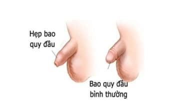 Nguyên nhân hẹp bao quy đầu, cách nhận diện và điều trị