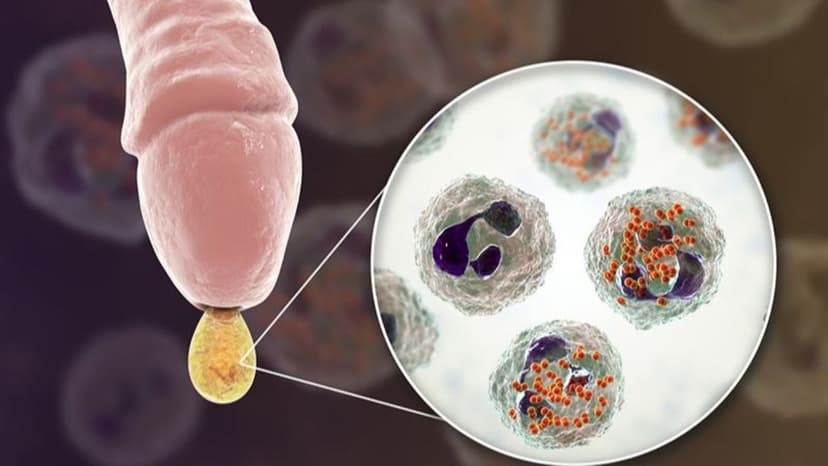 Mách mẹ những điều cần biết về hẹp bao quy đầu ở trẻ em