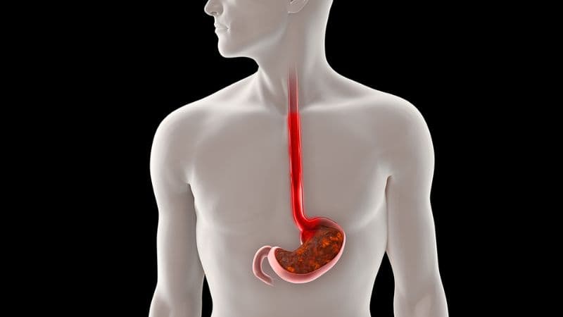 Trị viêm thực quản cần căn cứ vào nguyên nhân và triệu chứng