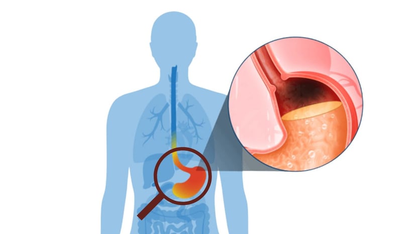 Chẩn đoán đúng xử lý ợ chua hiệu quả