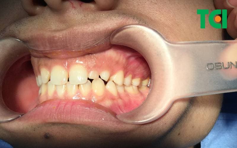 Nha khoa Dán sứ veneer Hà Nội