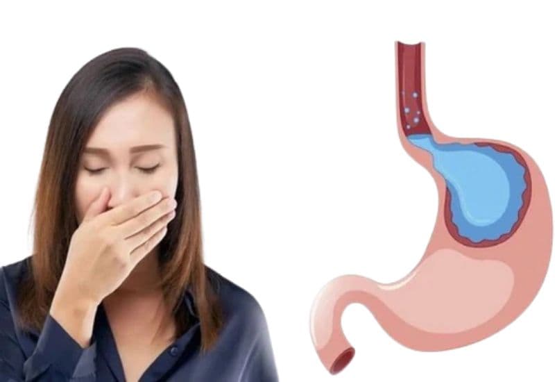 Mối liên hệ giữa ợ nóng rát cổ họng, ho kéo dài và GERD