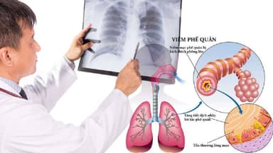 Hình ảnh viêm phế quản và cách nhận biết, điều trị