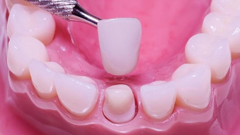 Bọc răng sứ chi phí thế nào – Tìm hiểu và cân nhắc hợp lý