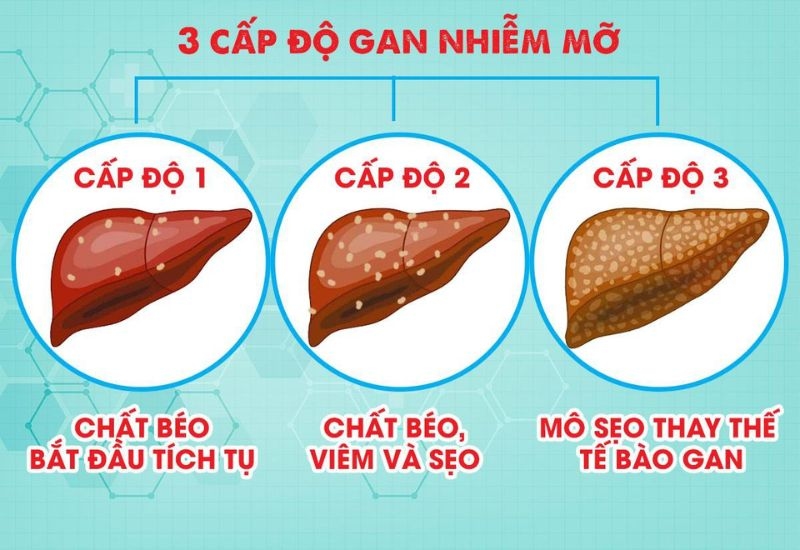 Các giai đoạn gan nhiễm mỡ quyết định cách điều trị