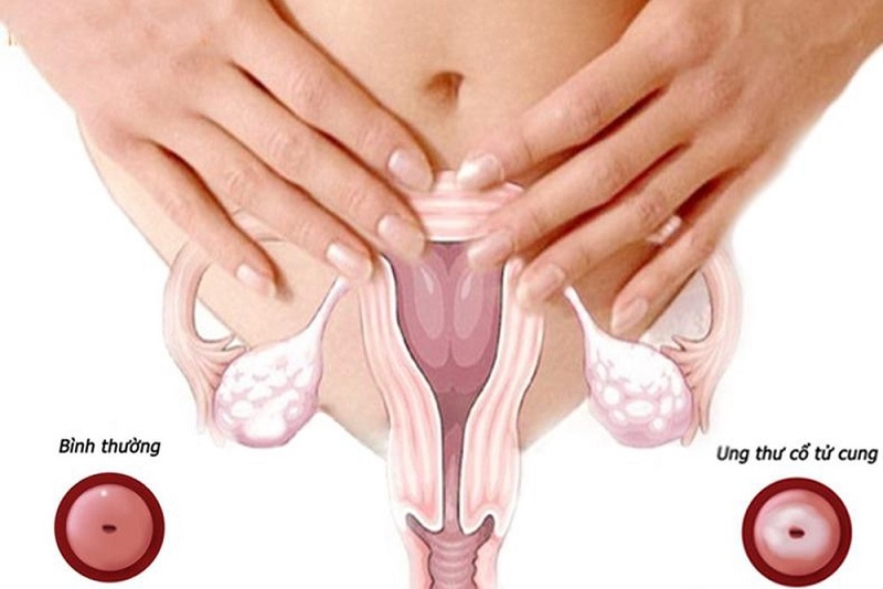 khám tsut cổ tử cung