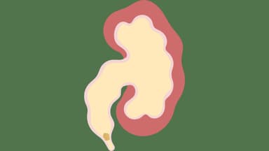 Thận ứ nước và sỏi thận: Mối liên hệ và cách phòng ngừa