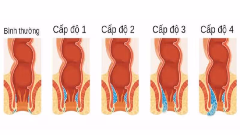 Trĩ nội có cần phẫu thuật, điều trị cần chú ý điều gì?