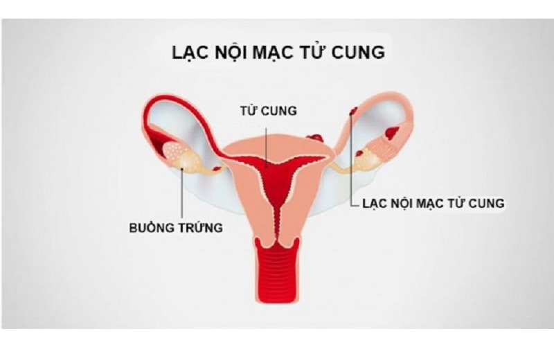 lạc nội mạc tử cung