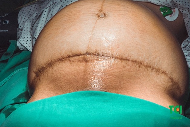 Tử cung chưa phục hồi, cơ thể còn yếu lý giải cho câu hỏi tại sao đẻ mổ không nên đặt vòng