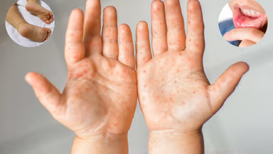 Nhận biết để phòng ngừa bệnh tay chân miệng ở trẻ sơ sinh