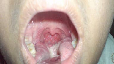 Biểu hiện viêm họng hạt bạn cần chú ý