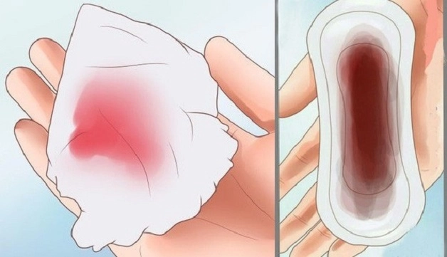 Chảy máu âm đạo là dấu hiệu của bệnh polyp âm đạo