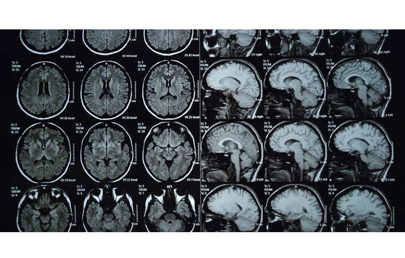 Trường hợp chỉ định chụp MRI vùng đầu cổ