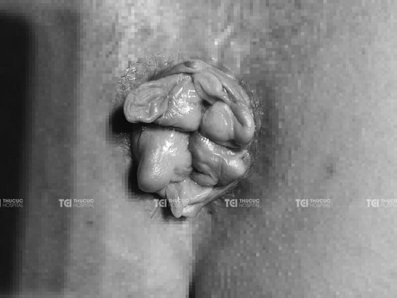 Dấu hiệu bệnh trĩ