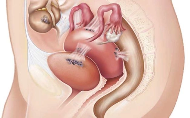 Lạc nội mạc tử cung tại tầng sinh môn là do những tế bào nội mạc tử cung dừng lại tại tầng sinh môn khi phụ nữ sinh con và có cắt tầng sinh môn