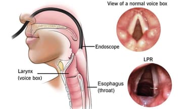 Nhận biết và điều trị viêm thanh quản đúng cách, hiệu quả