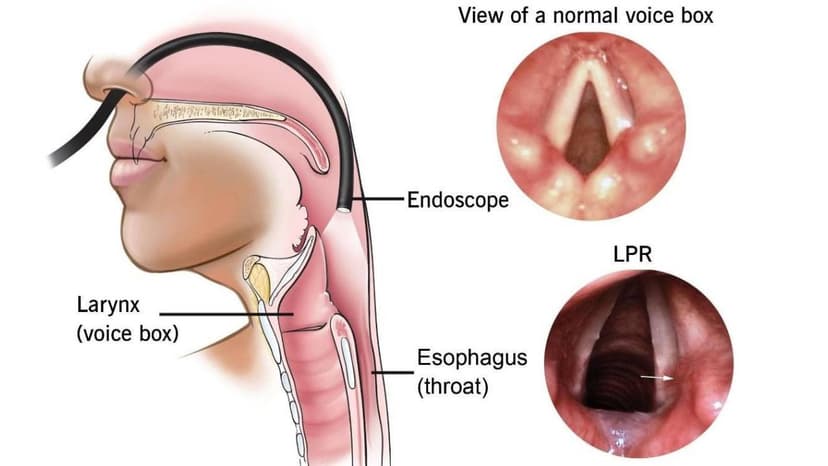 Nhận biết và điều trị viêm thanh quản đúng cách, hiệu quả