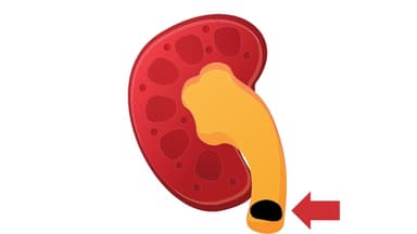 Giãn đài bể thận và niệu quản trái do sỏi niệu quản 1/3 trên