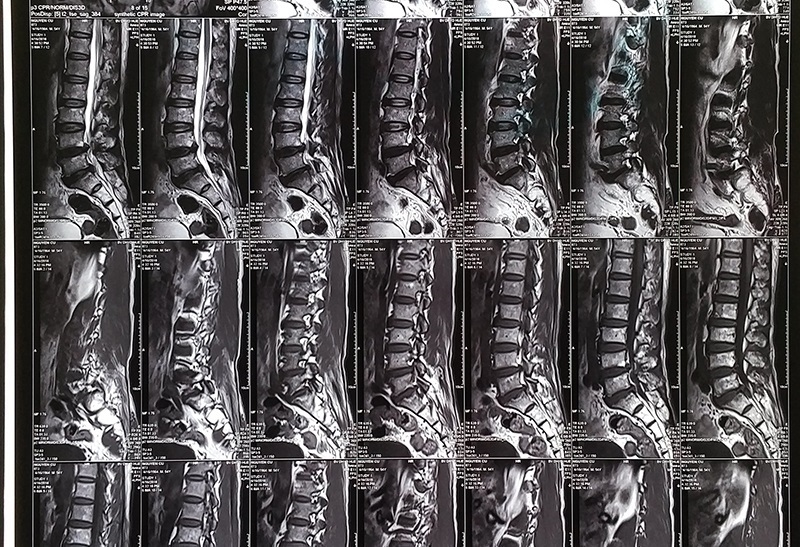 giá chụp chụp mri cột sống lưng
