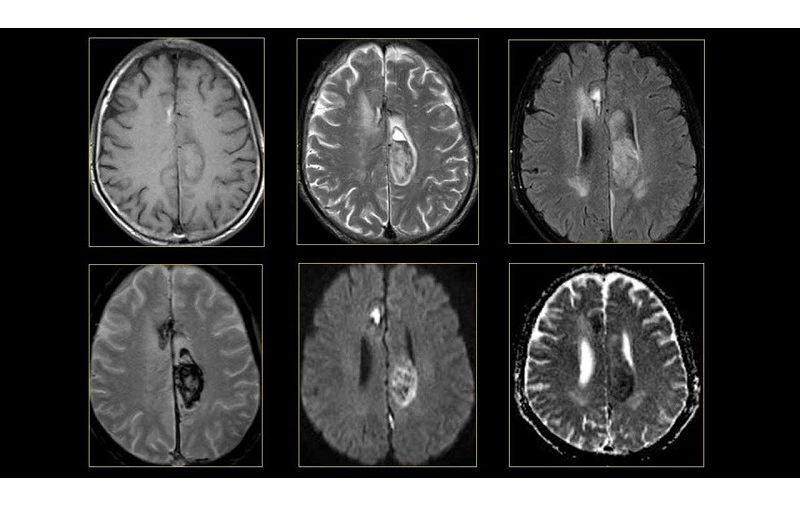 chụp MRI
