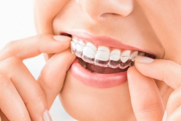 Niềng răng trong suốt Reveal Clear Aligners mang lại hiệu quả chỉnh nha vượt trội