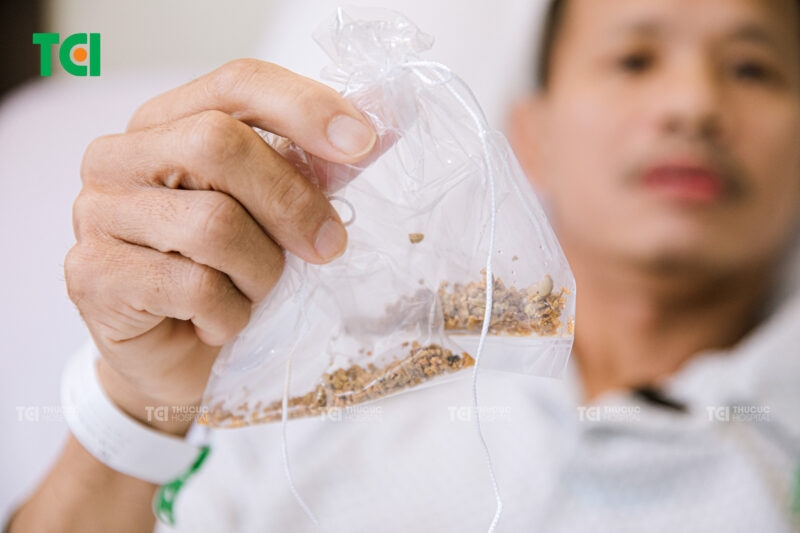 Các phương pháp điều trị hiệu quả đài bể thận giãn do sỏi