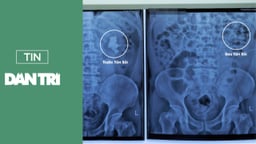 Thách thức tán sỏi san hô khổng lồ cho bệnh nhân hậu tai biến