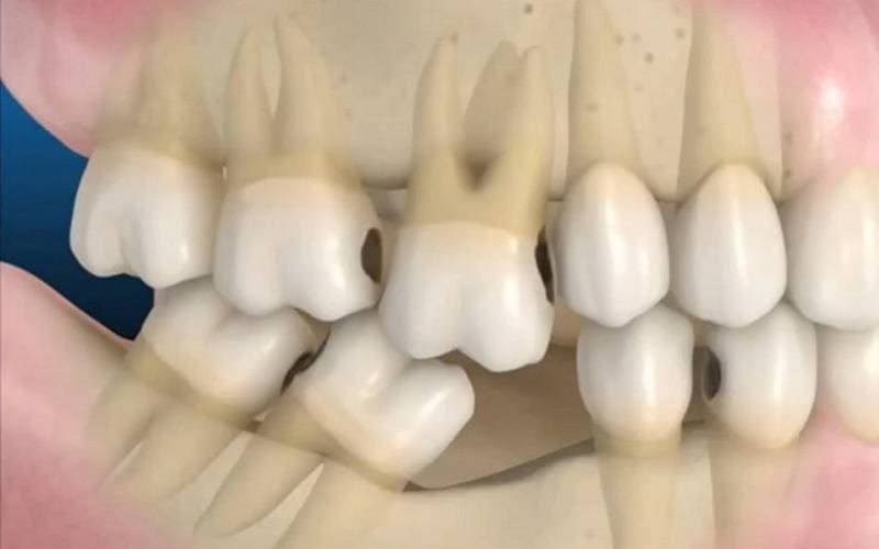 Trồng răng giả cách nào tốt