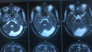 4 Phương pháp chẩn đoán hình ảnh u màng não phổ biến